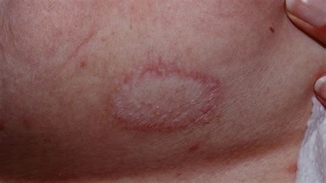 What Causes Lichen Sclerosus Of The Vulva - YouTube