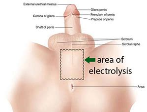 Most patients can have laser hair removal once every 4 to 6 weeks. Transsexual medical issues female to male - Nude photos