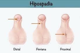 Hipospadias çocukluk yaşta onarılması gereken doğumsal bir anomalidir. Urología Pediátrica - Dr. Denis Olivares