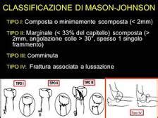 Frattura capitello radiale | Ortopedia Ospedale srl