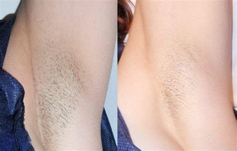 Many people find it less painful to use, it helps prevent ingrown hair, and it washes off easily. Natural Ways to Remove Unwanted Body Hair - Passion Life ...