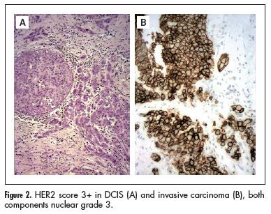 Comparison of nuclear grade and immunohistochemical ...