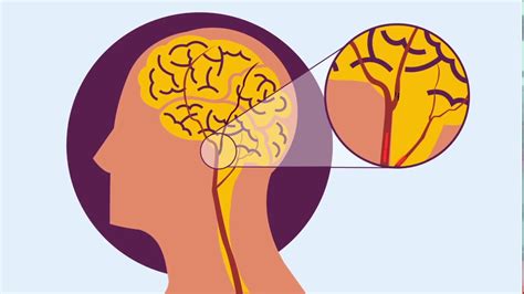 2 stroke means one stroke in each direction. What Does it Mean to be a Comprehensive Stroke Center ...