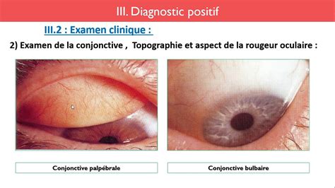 Oeil rouge : Diagnostic & traitement - Docteur LAYADI. C.H.U Bab El ...