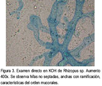 Hongos del género rhizopus (la causa más frecuente de mucormicosis), lichtheimia (absidia, mycocladus), mucor, con menor frecuencia rhizomucor, saksenaea, cunninghamella y. Mucormicosis cutánea en un recién nacido pretérmino: A ...