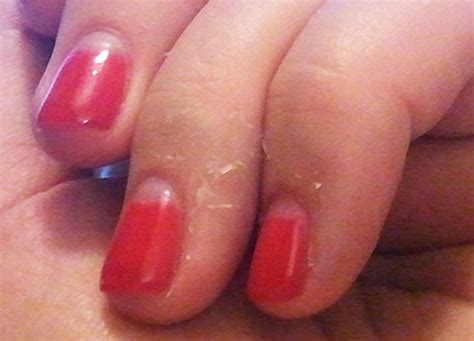 Peeling skin is unintended damage to and loss of the upper layer of your skin (epidermis). Nail Technicians | Derma Shield