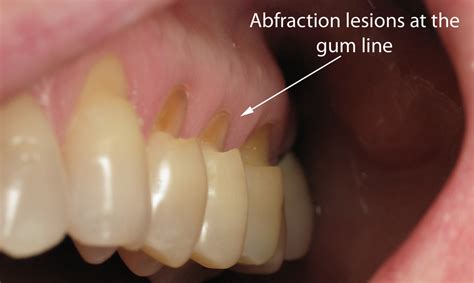 This begins to form the notching commonly associated with tooth abfraction. Abfraction | News | Dentagama