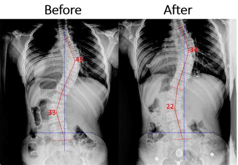 From gaps to overbites, to teeth or jaw alignment there are many factors that can affect while the time it takes for braces to do their thing varies greatly by patient, after an initial evaluation and consultation, dr. How long does it take for a scoliosis brace to work? - Quora