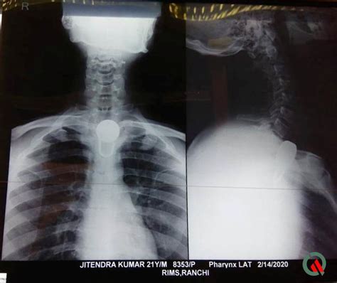 Thanks for your caring and support! Man swallows a 6cm padlock and gets it stuck down his ...