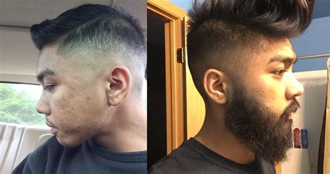 As a side effect hair growth was identified. Minoxidil beard before and after - BeardStylesHQ