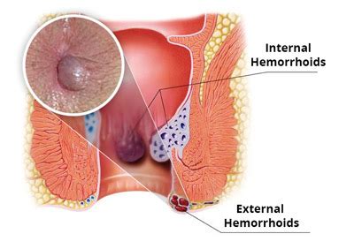 Passage of blood clots requires evaluation for colon lesions. Laser Hemorrhoid Treatment NYC | Hemorrhoid Doctor New York