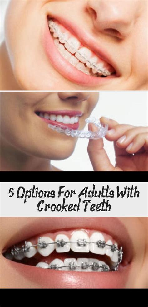 This is an encouraging number. 5 Options For Adults With Crooked Teeth | Crooked teeth ...