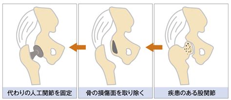女性に多い股関節の痛み。それは「変形性股関節症」かもしれ ...