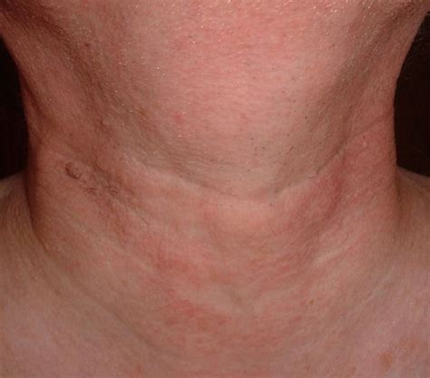 What are the treatment options for throat (laryngeal) cancer? Health Topics Blogs : Throat Cancer Pictures