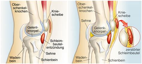 Knieschmerzen beim radfahren sind kein seltenes problem. Knieschmerzen verstehen: Harmlose Schmerzen oder Gefahr ...