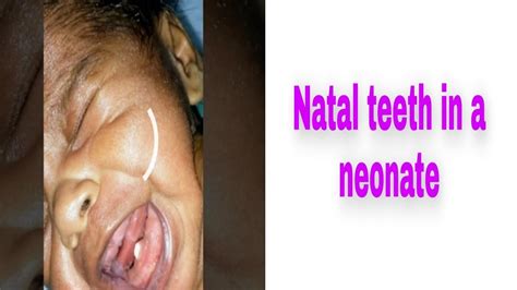 Management of natal and neonatal teeth. Natal teeth in a newborn # natal teeth #Child with a teeth ...