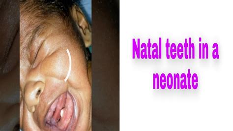 Management of natal and neonatal teeth. Natal teeth in a newborn # natal teeth #Child with a teeth ...