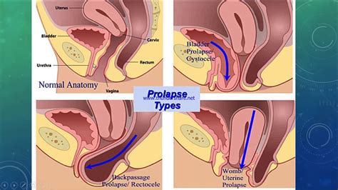 A prolapsed uterus happens when weakness in your muscles in the pelvic area allows for your uterus to begin sagging or ultimately come out of your body. Uterine prolapse, Cystocele and rectocele - YouTube
