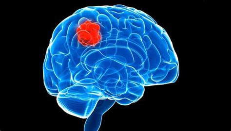 Brain tumors are masses of abnormal cells within the brain. Acoustic Neuroma: Common Symptoms of Benign Brain Tumor ...