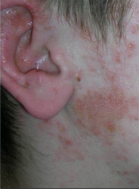 Impetigo, sometimes called puppy pyoderma, is a type of skin infection most commonly seen in young or adolescent dogs. Impetigo - Dermatology Advisor