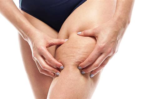 Controlling the appearance of cellulite: Cellulite: un rimedio pratico e economico a questo ...