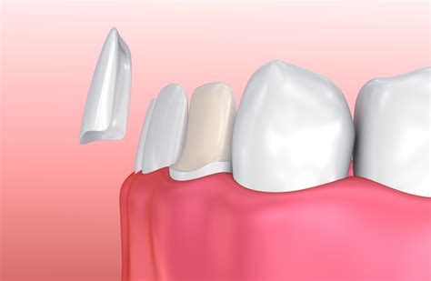 Mello adds, sometimes patients think they want veneers but what they need are orthodontics. Dental Veneers Manchester | Porcelain Veneers | Cosmetic ...