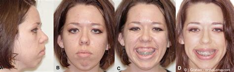 If the cause of gummy smile is entirely due to excess proclination of your upper teeth leading to thin hypotonic lip then yes putting on braces to correct underlying malocclusion may help reducing your gummysmile gummy smiles, and how to fix them. Correction of a severe gummy smile without surgery | Bücco