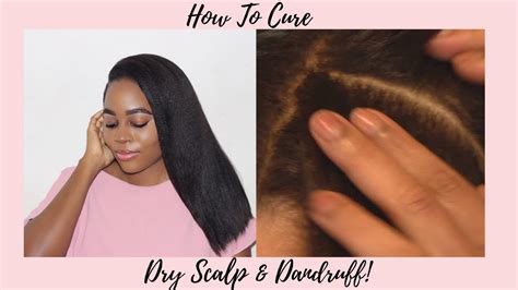 The distinctive flakes and scales caused by dandruff. HOW TO CURE ITCHY, DRY SCALP & DANDRUFF (FOR HAIR GROWTH ...