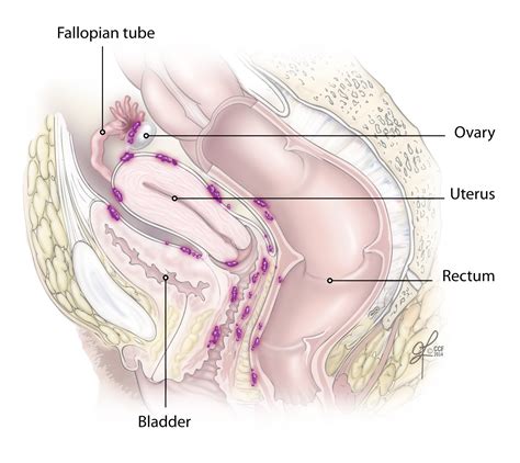 On this page what causes ovarian cancer? (PDF) Vaginal cancers and human papilloma virus Can hpv ...