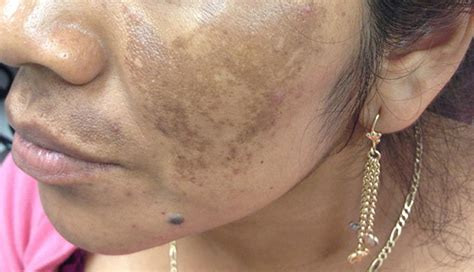 Dry itchy white patches on skin from eczema and psoriasis 5. Derm Dx: Brown patches on the face - Clinical Advisor