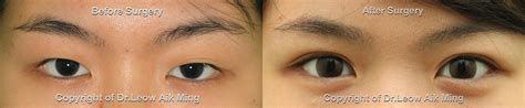 In some individuals, weakness is most prominent in muscles that control movements of the eyes and eyelids. Epicanthal Folds Vs Normal Eye ~ news word