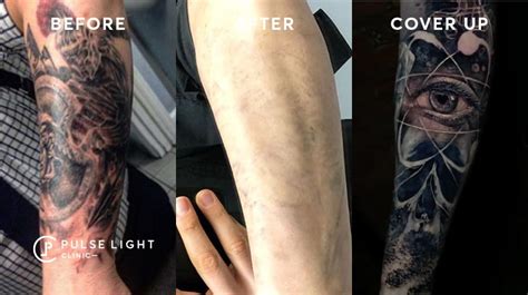 We have the expertise to give you the design you want. Tattoo Removal Cover Ups London | Pulse Light Clinic London