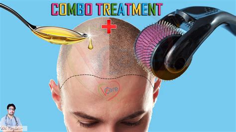 How do i clean the dermaroller? DIY HAIR LOSS TREATMENT COMBINATION OF DERMA ROLLER ...