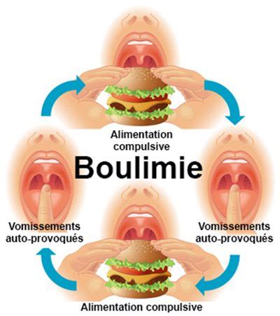 Le traitement précoce, médical et psychologique de l'anorexie mentale est un facteur déterminant de guérison. Boulimie : symptômes, traitement, définition - docteurclic.com