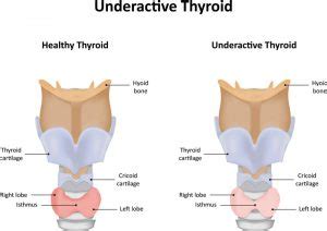 Early signs of thyroid problems are thus not that common in teens, and other characteristics of puberty are possibly confused with thyroid problem symptoms. Top 7 Symptoms of Hypothyroidism in Men | Your Body Can Heal