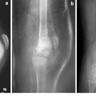 Accurate examination of the location of the bone deformity is important for treatment. (PDF) Treatment of fixed knee flexion deformity and crouch ...