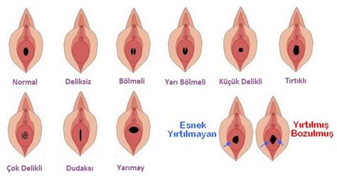An operation does exist and is performed in some countries (sometimes illegally) that can cut open the fragments of a broken hymen and sew them back together to form a likeness of an. Kızlık Zarı Hakkında Bilmeniz Gereken Her Şey | Vajina ...