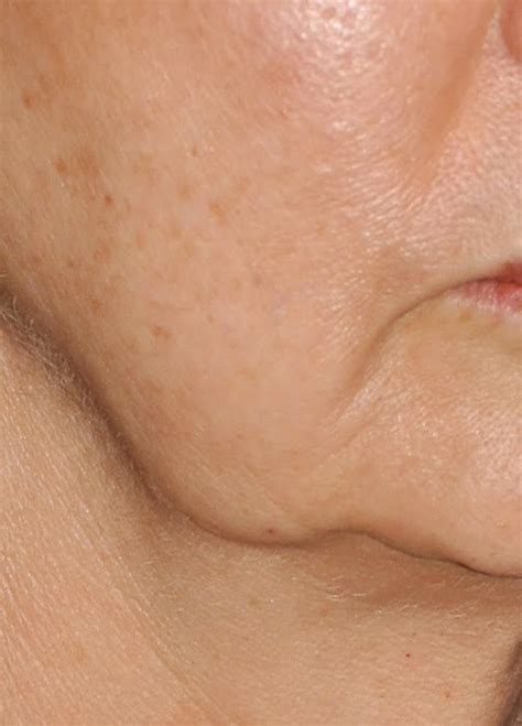 There are a number of ways jowls and sagging skin happen, from the usual suspects like sun damage and smoking to genetics and weight loss (if that last one doesn't seem fair, it's because it's not). Jowls - Kalpana Aesthetics