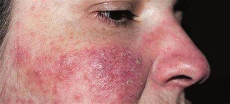 Экзема истинная диета Экзема На Ногах Лечение Мази Фото — Картинки фотографии Экзема На Ногах Лечение Мази Фото — Картинки фотографии Экзема истинная диета