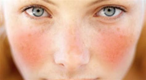Rossore in viso? Ecco cosa potrebbe essere e come curarlo