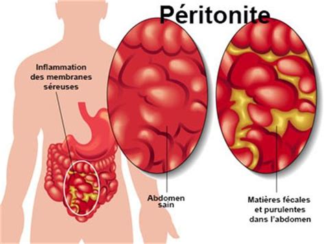 Ainsi que des témoignages d'internautes. Péritonite : symptômes, traitement, définition ...