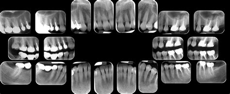 Got my biopsies results showed mild inflammation. Bilan long cone - Imagerie Paris La Defense