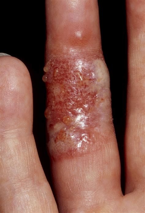 Oral zinc improves the skin within days. Herpetic Whitlow - Musculoskeletal and Connective Tissue ...