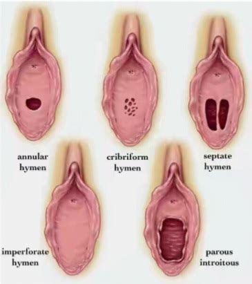 Malam pertama tidak berdarah disebabkan selaput dara kaku, kurang elastis atau tidak perawan. Jenis-Jenis Selaput Dara (Hymen) - Info Pendidikan dan Biologi