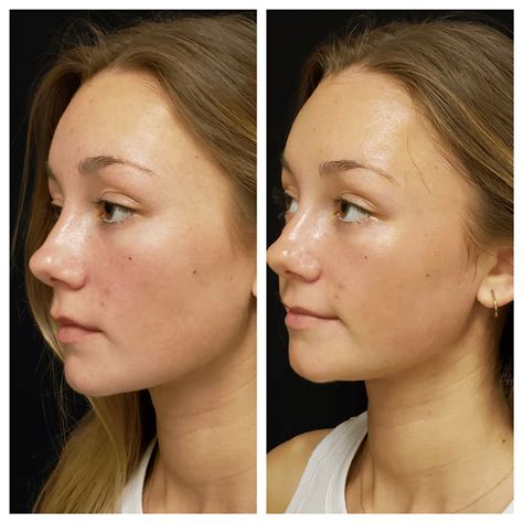 Superb Sculpting | HydraFacial Before After Pictures | Fort Myers FL