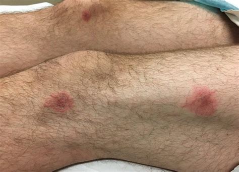 It's not bumpy, blistered, or raised. Case Study: A gradually progressive rash after a URI ...