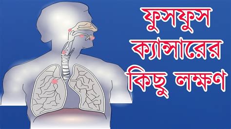 The most common types of lung cancer are those found right in the lungs. The most common Symptoms of Lung Cancer - YouTube