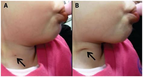 Cysts and fistulous tracts of branchial origin are unusual entities seldom seen by radiologists. The "dimple swallow" sign for branchial cleft anomalies | CMAJ