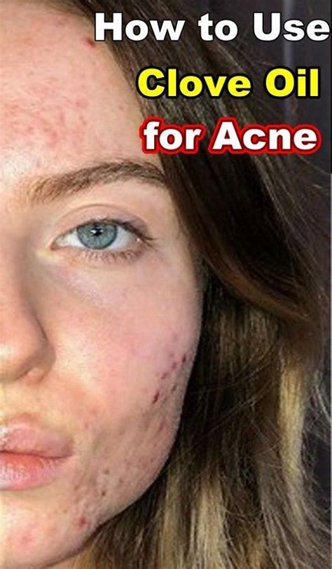 Use hibiclens as you would any other liquid soap. How to Use Clove Oil for Acne ? | Clove oil, Acne oil ...