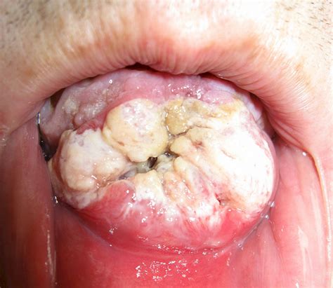 What do you know about these medical breakthroughs (e.g. Family dental health: Oral cancer ; Important facts